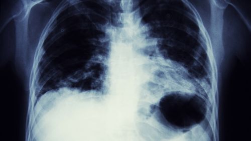 肺癌筛查可以挽救数千人的生命。