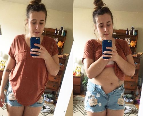Woman reveals battle with eating disorder with body-positive photo