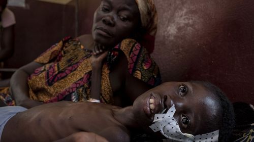 Aimenc Zingho, 18 months, is treated for severe acute malnutrition at the UNICEF-supported Pediatric Clinic in Bangui, Central African Republic.