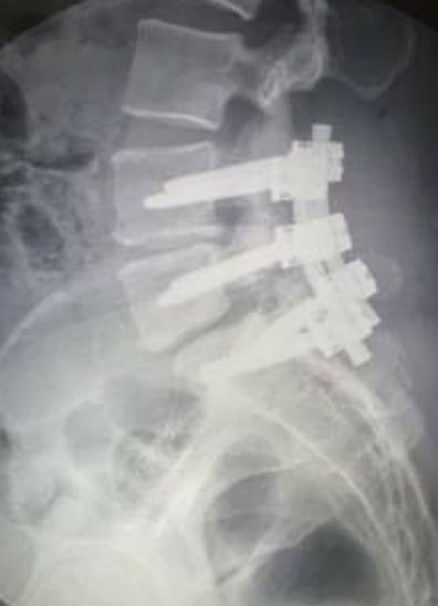 Trudy car accident recovery spinal fusion