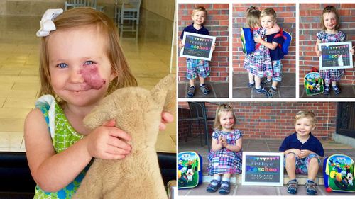 Toddler with facial birthmark uses unwelcome attention to educate others