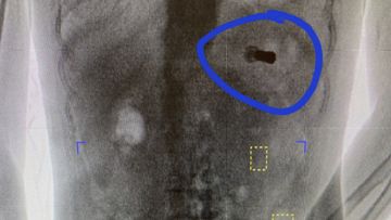 This undated body scan shows an apparent shotgun shell inside the body of a person who was being booked into the lockup. Prisoners entering the Morgan County Jail routinely undergo a body scan when being admitted.