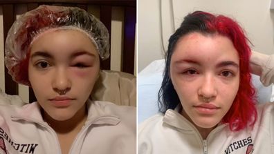 Teen suffers severe allergic reaction after dyeing her own hair: 'Scary experience'