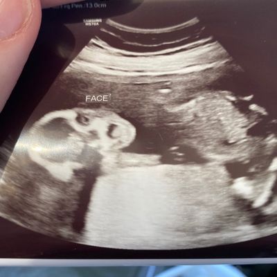 Funny and strange ultrasound photos parents have shared