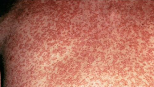 Measles usually begins with a runny nose, red eyes and a cough before developing into a fever and severe rash. (Supplied)