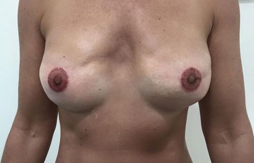 Breast cancer survivors' nipple tattoos. (Facebook)