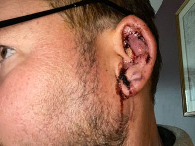 Alexander Gupman had surgery on his ear.