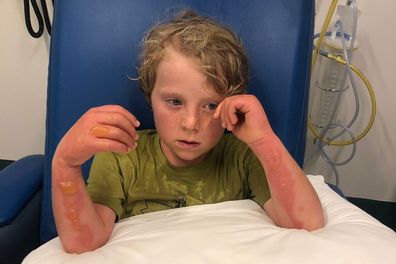 NSW mum Catherine Kerr's son suffered 'margarita burns' after juicing limes and playing in the sunshine.
