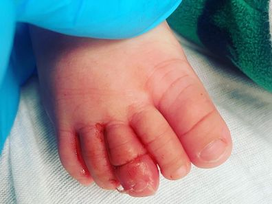 Hair tourniquet on baby's toe. 