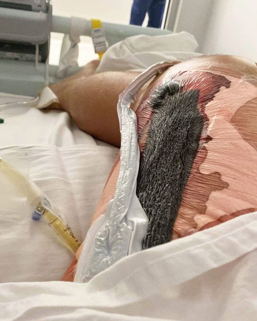 Michael Lindquist's leg, dressed with a vacuum seal, after his first surgery.