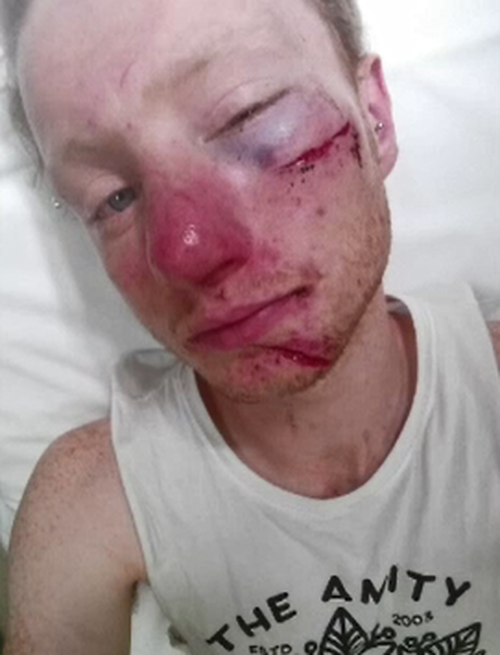 Bashgen Bloomfield, 21, had to take time off work following the brutal assault. (9NEWS)