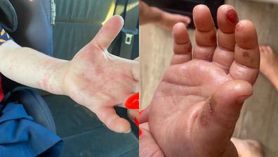 Boy's hand covered in hives after touching a hairy caterpillar.