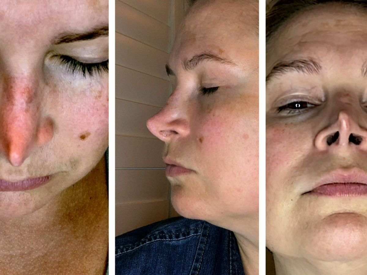 What A Mini Facelift Can (and Can't) Do: Alexis Furze, MD