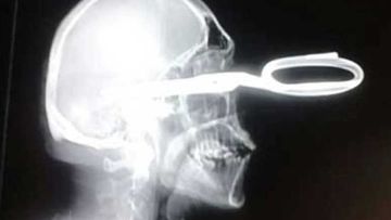 A Mexican man has stunned doctors with his calm demeanour after presenting at an ER with scissors embedded in his brain.