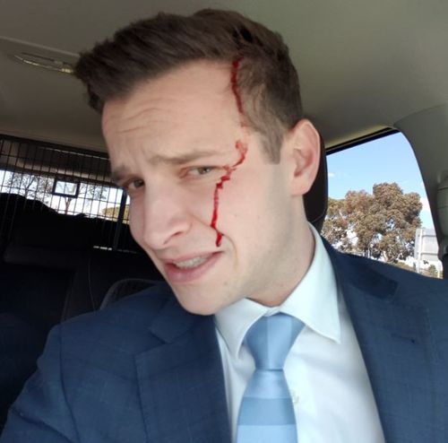 Mark Santomartino was left with blood down his face after the magpie attack.