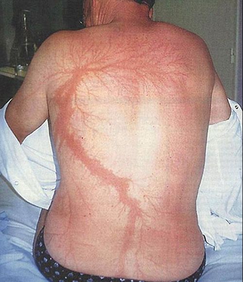 This photo of a lightning strike survivor shows the feathered markings left on his body by the electrical charge.