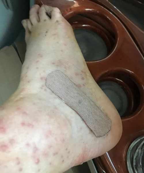 Mosquito bites coupled with standing in mud for hours saw Alice Monfries suffer from an infection.