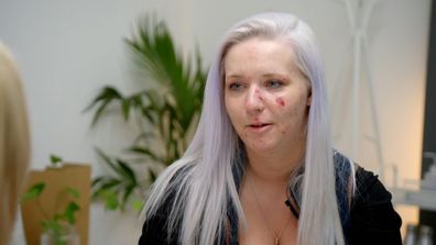 Hannah has severe skin condition on Embarrassing Bodies on 9Now