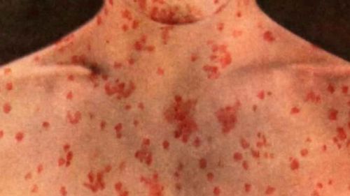 Measles warning issued for Sydney after case diagnosed in CBD