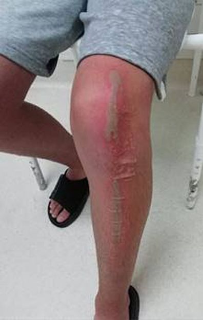 14-year-old Aiden sustained burns to his hand and deep burns and nerve damage to his leg after attempting the TikTok Squid Game honeycomb challenge.