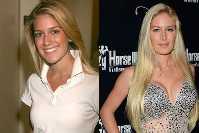 It seemed like Heidi Montag's motto was "go hard or go home" when she underwent a marathon 10-hour surgical overhaul in 2010. The Hills star had her ears pinned back, a mini brow lift, nose-job revision, chin reduction, neck liposuction, butt augmentation, liposuction on waist and thighs, botox and breast implatns. "I am absolutely beyond obsessed," she told People Magazine, "I was made fun of when I was younger, and so I had insecurities. I just wanted to feel more confident and look in the mirror and be like, 'Whoa! That's me!' I was an ugly duckling before."  Co-stars like Lauren Conrad and Whitney Port went on to achieve greater success, unfortunately Heidi's career, much like her looks, have lagged behind. Yeowch!