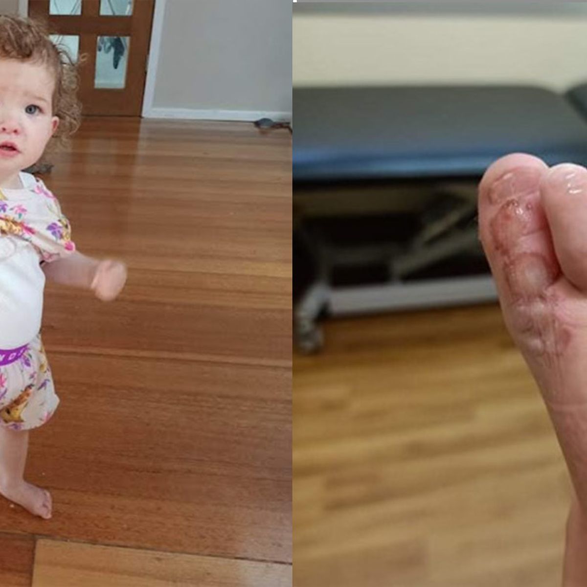 Three-year-old WA girl suffers horrific friction burns after treadmill  accident