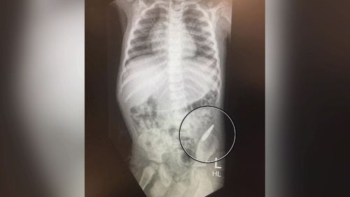 The bullet lodged in Hunter's colon.