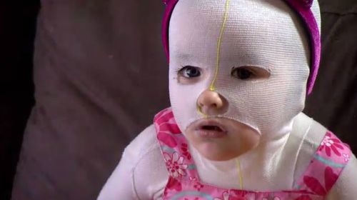 Two-year-old Monroe Mills suffers from a rare skin disease which means she can never play out in the sun. (A Current Affair)