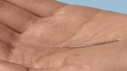 The Essure coil has been known to corrode inside women's bodies, or migrate.