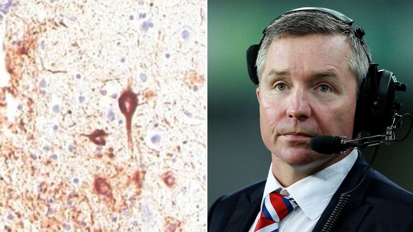 The impact of CTE can be seen clearly in Paul Green&#x27;s brain scan.