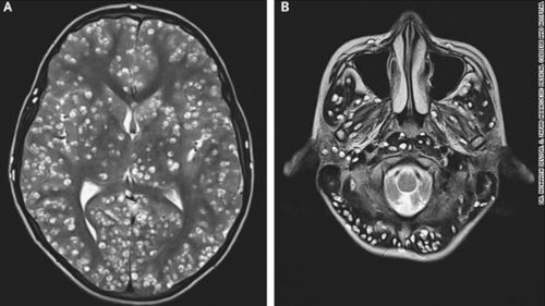 Indian teen dies of tapeworm egg infestation in brain