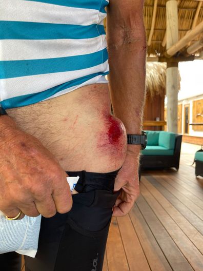 Richard Branson horror bike crash injuries