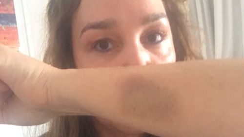 The radio star shared an image of her bruised arm to Twitter. (Twitter)