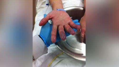Nurses told the woman the worst case scenario would see her lose her hands. (Imgur)