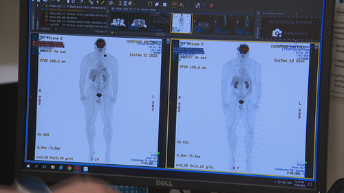 A new therapy has flipped the cancer paradigm on its head by giving the body the best opportunity to activate its own cancer-fighting defences.
