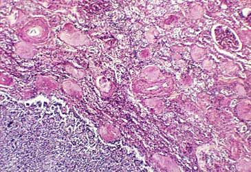 In which organ do renal cell carcinomas originate?