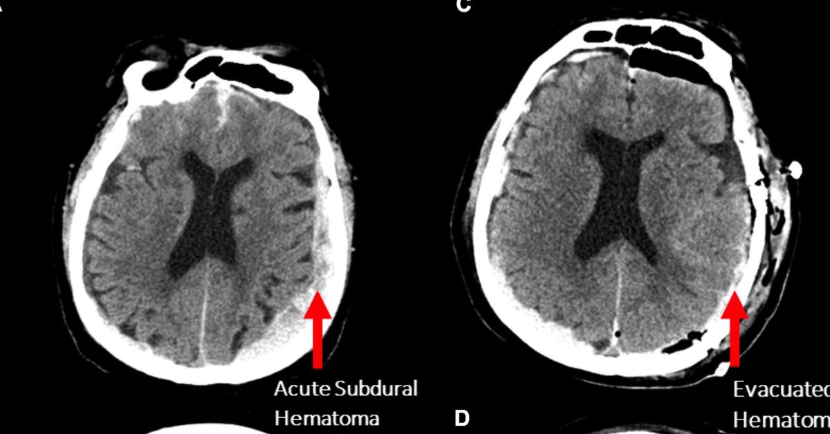 First-ever recording of a dying human brain shows we may relive memories before death - 9News