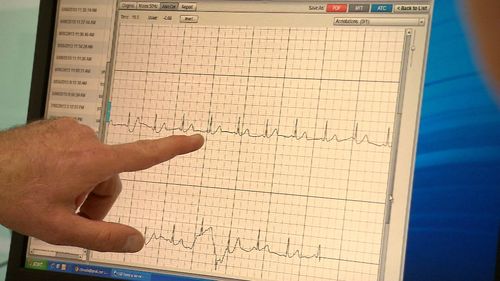 The condition makes the heart's upper chambers beat chaotically, out of sync with the rest of the heart. Picture: 9NEWS 