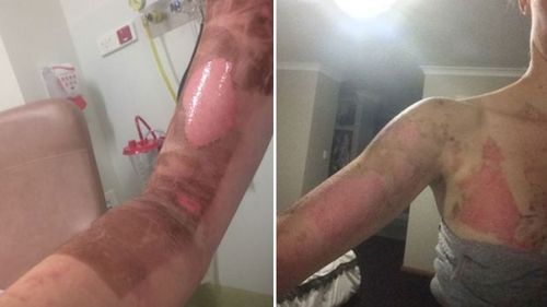 Perth mum burned when her 'Thermomix exploded'