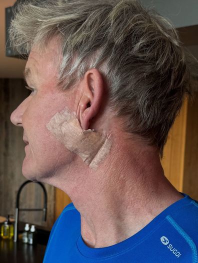 Gordon Ramsay belatedly reveals skin cancer diagnosis with post-surgery pictures