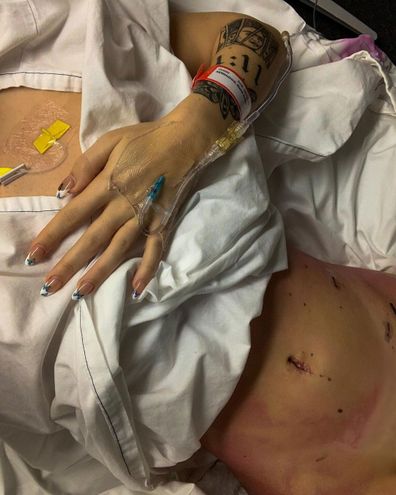 Niamh Anaya shows the incisions from endometriosis surgery.