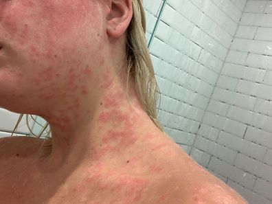 Ash Kent psoriasis