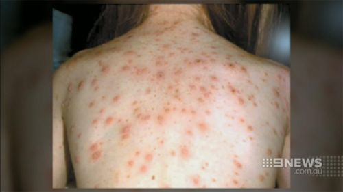 Measles is known for its severe rash and fever, and cause inflammation of the brain or death. (9NEWS)