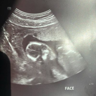 Funny and strange ultrasound photos parents have shared