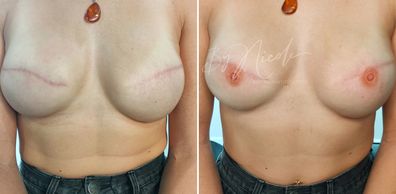Before and after Nicole Prance tattooed nipples over this client's mastectomy scars.
