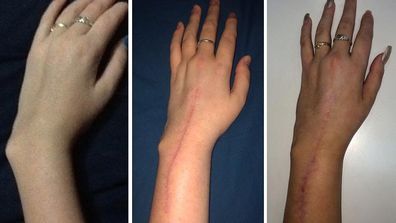 Sharyce Helyar captioned this photo on Instagram: "It is amazing what 2 operations, 15 screws and 2 titanium plates can do! I'm so glad my wrist doesn't look like that anymore!"