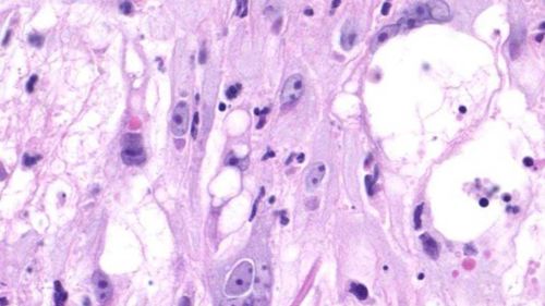 The primary innoculation lesion for monkeypox infection.