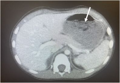 An abdominal CT showing the debris.