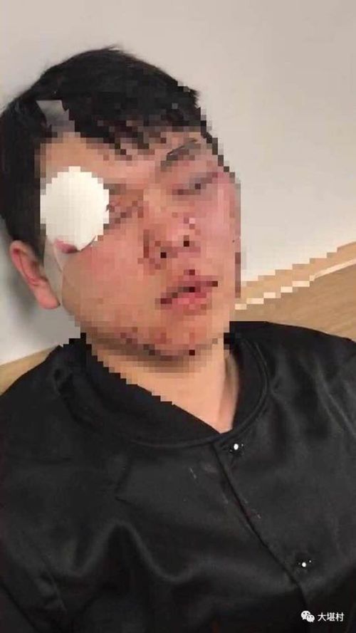 A bandage covers half the eye of an international student allegedly assaulted. Picture: Supplied.