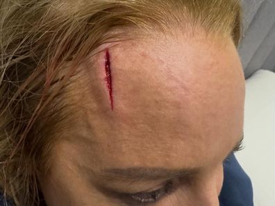 Carrie Bickmore smashed her head and has to undergo surgery after walking into a wall